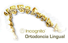 Ortodoncia Lingual Incognito en Madrid